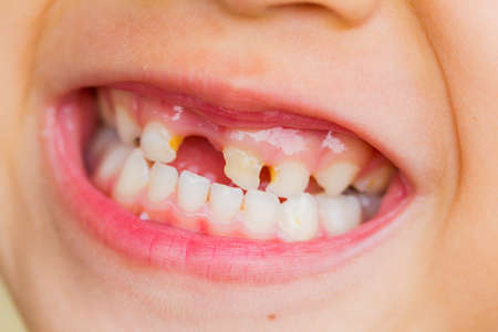 selective focus broken teeth of asian little girl.の写真素材