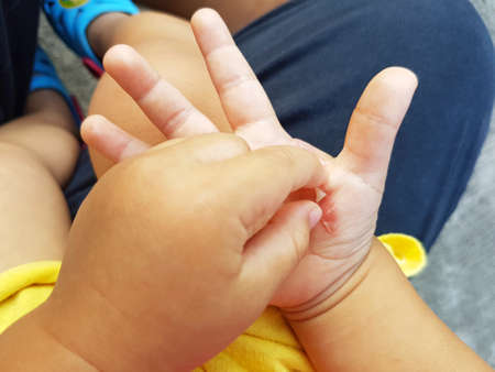 closeup child trying to wrest the skin from an iron burnの写真素材