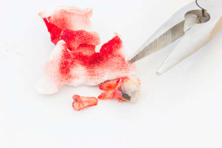 Extraction of decayed tooth with bloody gauze pad with pliers on white background.の写真素材