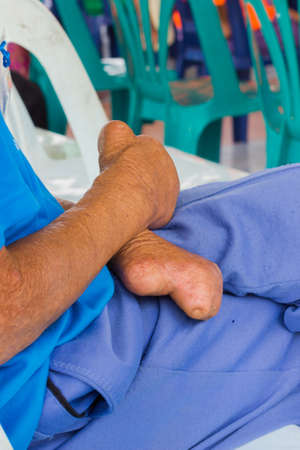closeup hand of old asian man suffering from leprosy, amputated hand