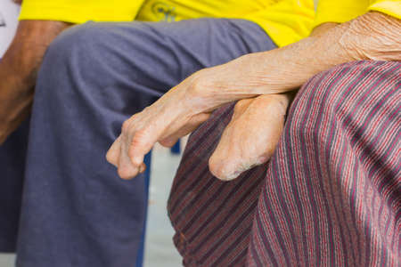 closeup hand of old asian man suffering from leprosy, amputated handの写真素材