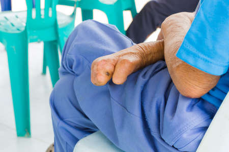 Closeup hand of old asian man suffering from leprosy, amputated handの写真素材