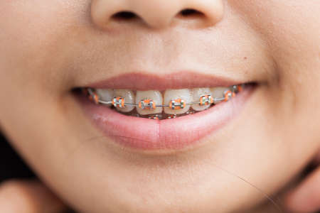 Closeup Ceramic and Metal Braces on Teeth. Broad Smile with Self-ligating Brackets. Orthodontic Treatment. Woman Smiling Showing Dental Braces.の写真素材