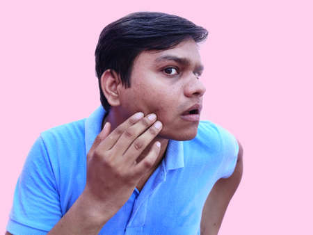 Young adult having pimple or acne marks on faceの写真素材