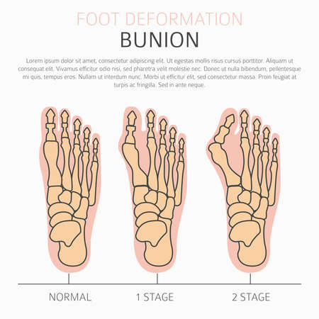 Foot deformation as medical desease infographic. Causes of bunion. Vector illustrationのイラスト素材