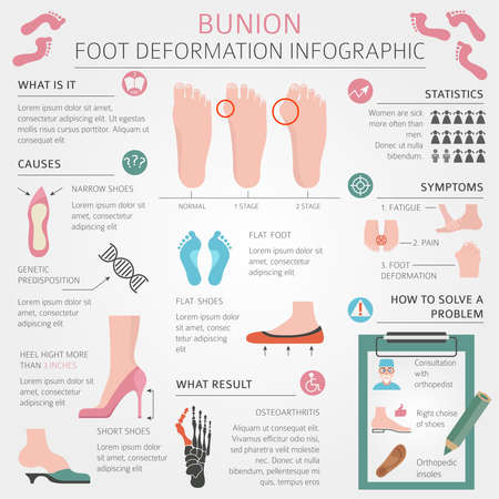 Foot deformation as medical desease infographic. Causes of bunion. Vector illustrationのイラスト素材