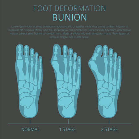 Foot deformation as medical desease infographic. Causes of bunion. Vector illustrationのイラスト素材