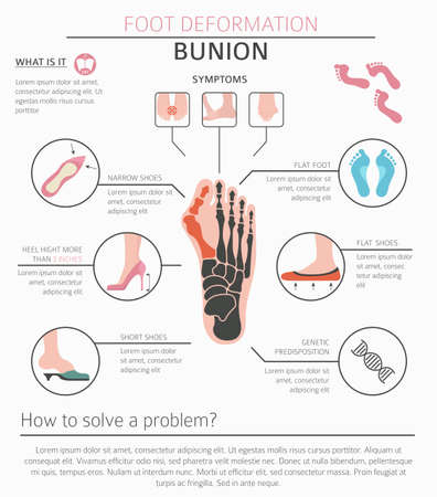 Foot deformation as medical desease infographic. Causes of bunion. Vector illustrationのイラスト素材