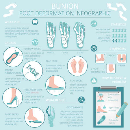 Foot deformation as medical desease infographic. Causes of bunion. Vector illustrationのイラスト素材