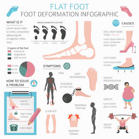Foot deformation as medical desease infographic. Causes of Flat foot. Vector illustrationのイラスト素材