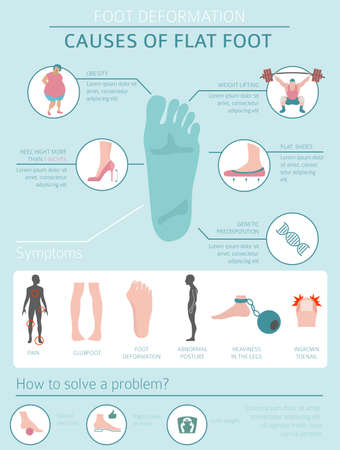 Foot deformation as medical desease infographic. Causes of Flat foot. Vector illustrationのイラスト素材