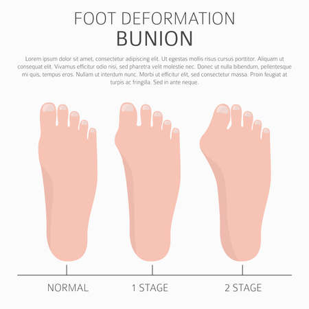 Foot deformation as medical desease infographic. Causes of bunion. Vector illustrationのイラスト素材