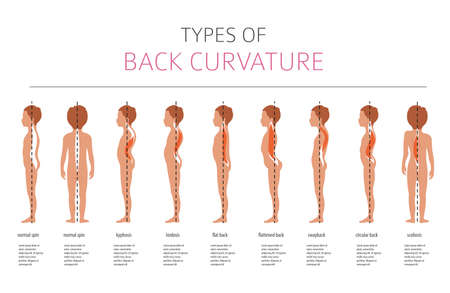 Types of back curvature. Medical desease infographic. Vector illustrationのイラスト素材