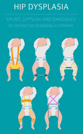 Foot deformation types,  medical desease infographic. Hip dysplasia in children. Vector illustrationのイラスト素材