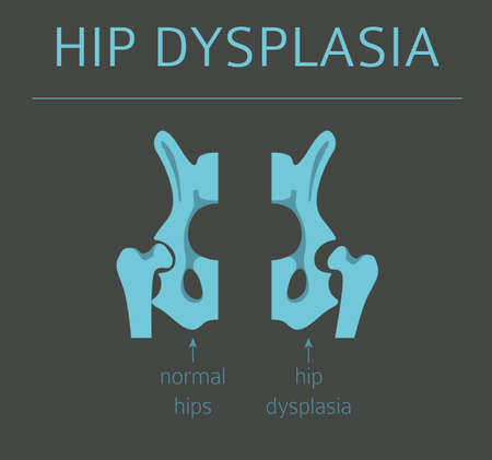 Foot deformation types,  medical desease infographic. Hip dysplasia in children. Vector illustrationのイラスト素材
