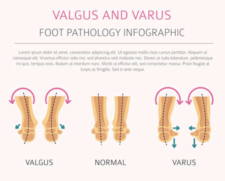 Foot deformation as medical desease infographic. Valgus and varus defect. Vector illustrationのイラスト素材