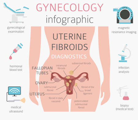 Uterine fibroids. Ginecological medical desease in women infographic. Vector illustrationのイラスト素材