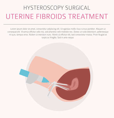 Uterine fibroids. Ginecological medical desease in women infographic. Vector illustrationのイラスト素材