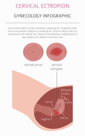 Cervical ectropion. Ginecological medical desease infographic. Vector illustrationのイラスト素材