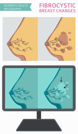 Fibrocystic breast changes disease, medical infographic. Diagnostics, symptoms, treatment. Women`s health icon set. Vector illustrationのイラスト素材