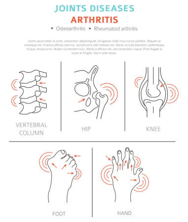 Joints diseases. Arthritis symptoms, treatment icon set. Medical infographic design.  Vector illustrationのイラスト素材