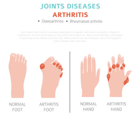 Joints diseases. Arthritis symptoms, treatment icon set. Medical infographic design.  Vector illustrationのイラスト素材