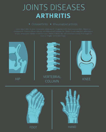 Joints diseases. Arthritis symptoms, treatment icon set. Medical infographic design.  Vector illustrationのイラスト素材