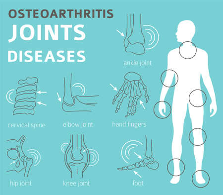 Joints diseases. Arthritis, osteoarthritis symptoms, treatment icon set. Medical infographic design. Vector illustrationのイラスト素材