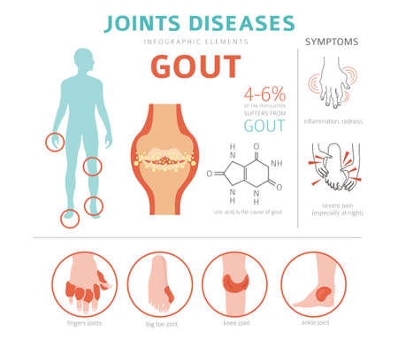 Joints diseases. Gout symptoms, treatment icon set. Medical infographic design. Vector illustrationのイラスト素材