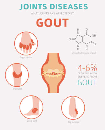 Joints diseases. Gout symptoms, treatment icon set. Medical infographic design. Vector illustrationのイラスト素材