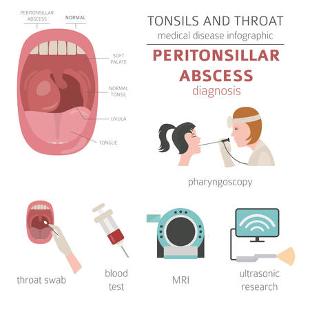 Tonsils and throat diseases. Peritonsillar abscess symptoms, treatment icon set. Medical infographic design. Vector illustrationのイラスト素材