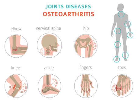 Arthritis, osteoarthritis medical infographic design. Joint replacement, implantant. Vector illustrationのイラスト素材