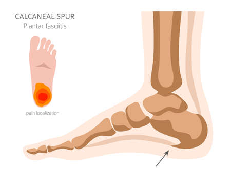 Calcaneal spur. Plantar fasciitis set. Medical desease infographics collection. Vector illustrationのイラスト素材