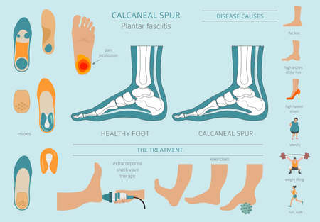 Calcaneal spur. Plantar fasciitis set. Medical desease infographics collection. Vector illustrationのイラスト素材