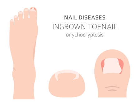 Nail diseases. Onychocryptocosis, ingrown toenail. Medical infographic design. Vector illustrationのイラスト素材