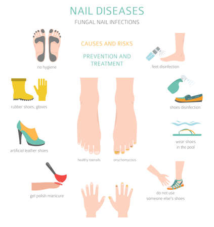 Nail diseases. Onychomycosis, nail fungal infection causes, treatment icon set. Medical infographic design. Vector illustrationのイラスト素材