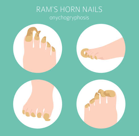 Nail diseases. Onychogryphosis, Ram`s horn nail. Medical infographic design. Vector illustration