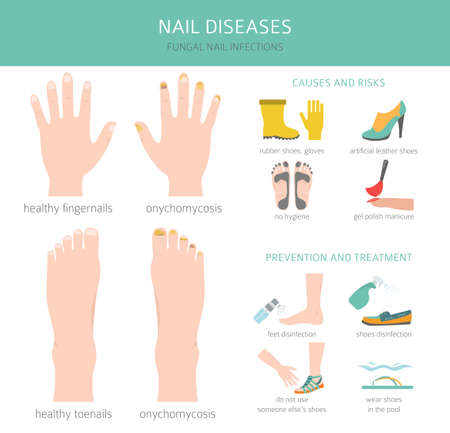 Nail diseases. Onychomycosis, nail fungal infection causes, treatment icon set. Medical infographic design. Vector illustrationのイラスト素材