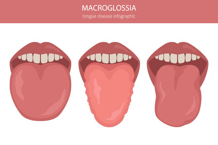 Macroglossia tongue disease. Oral medicine. Medical infographic design. Vector illustrationのイラスト素材