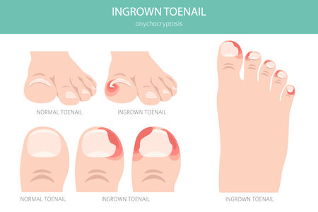 Ingrown toenail, or onychocryptosis, is a nail condition causing pain, redness, and swelling as the nail grows into the skin. Medical infographic. Vector illustrationのイラスト素材