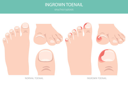 Ingrown toenail, or onychocryptosis, is a nail condition causing pain, redness, and swelling as the nail grows into the skin. Medical infographic. Vector illustrationのイラスト素材