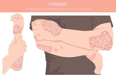 Psoriasis. Skin diseases. Medical infographic design. Vector illustrationのイラスト素材