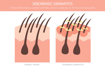 Seborrheic dermatitis. Skin diseases. Medical infographic design. Vector illustrationのイラスト素材
