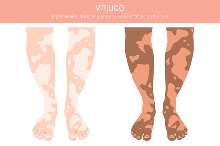 Vitiligo. Skin diseases. Medical infographic design. Vector illustrationのイラスト素材