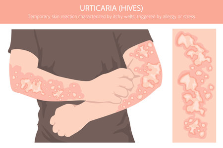 Urticaria. Hives. Skin diseases. Medical infographic design. Vector illustrationのイラスト素材