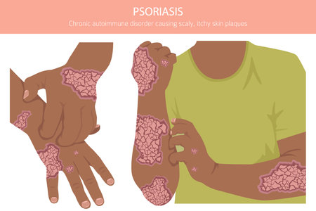 Psoriasis. Skin diseases. Medical infographic design. Vector illustrationのイラスト素材