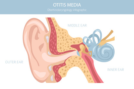 Otitis media. Infection in the middle ear. Otological disorders infographic. Vector illustrationのイラスト素材