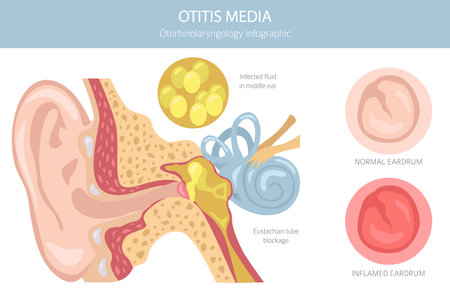 Otitis media. Infection in the middle ear. Otological disorders infographic. Vector illustrationのイラスト素材