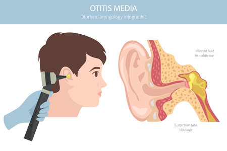 Otitis media. Infection in the middle ear. Otological disorders infographic. Vector illustrationのイラスト素材