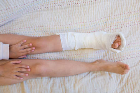 broken leg. Close-up of the cast on the feet. exercises to repair and strengthen muscles. damage to the bones. medical care of a surgeon in the emergency roomの写真素材